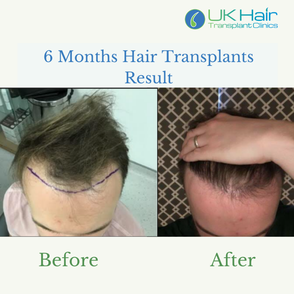 UK Hair Transplant Clinics Manchester gallery photo