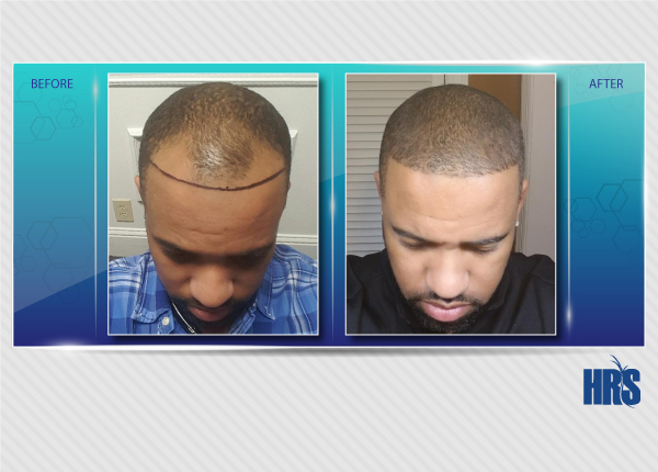 Hair Restoration Specialists gallery photo