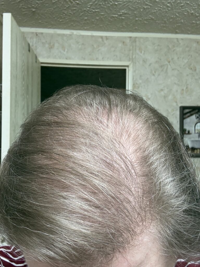 Carolina Hair Surgery: FUE Hair Transplant gallery photo