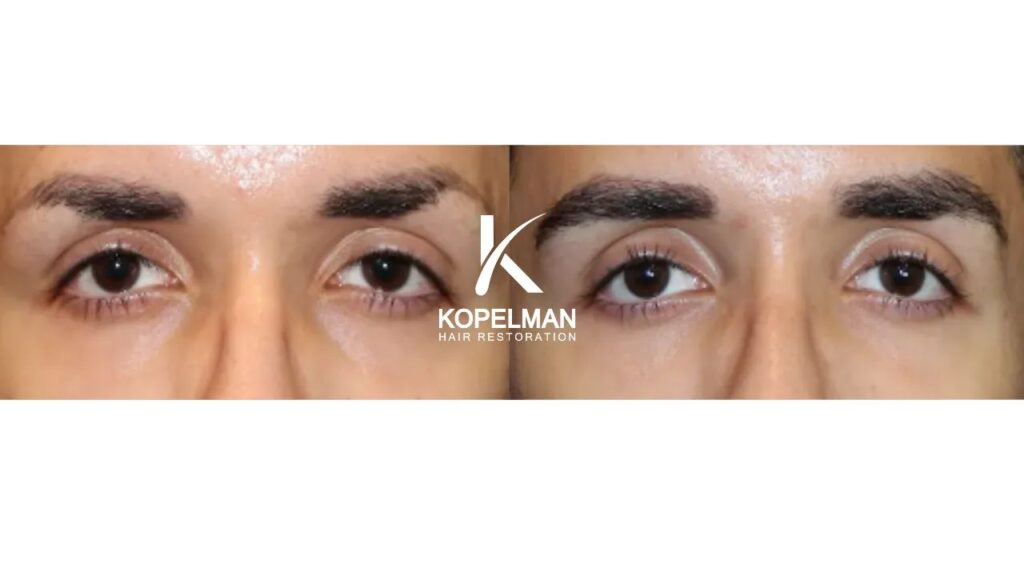 Kopelman Hair Restoration NJ: Hair Transplant Clinic gallery photo