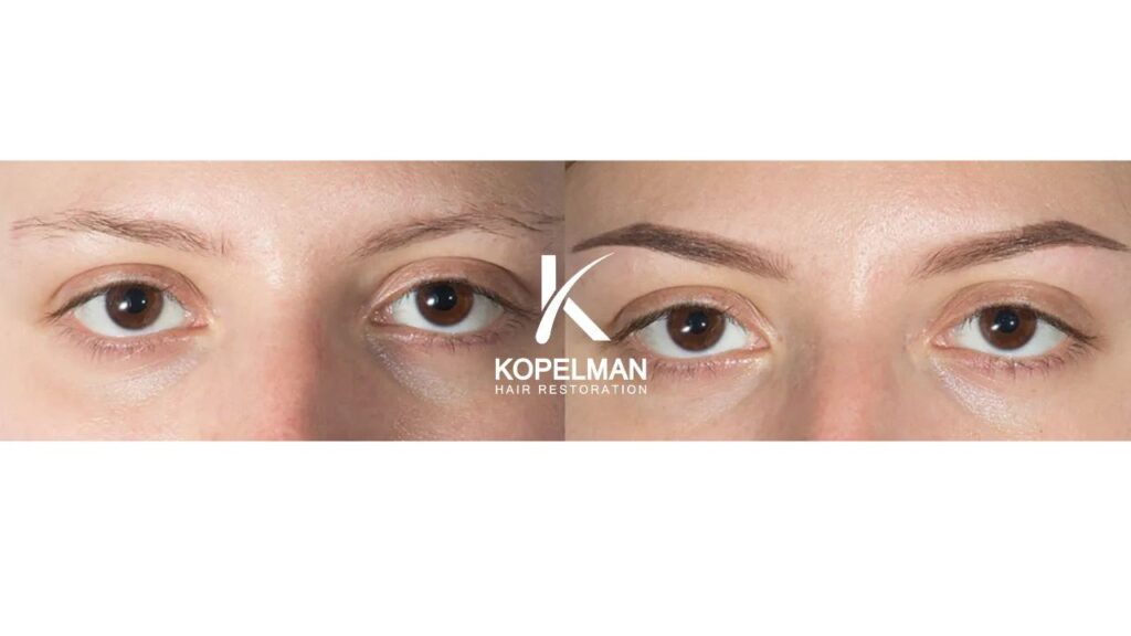 Kopelman Hair Restoration NJ: Hair Transplant Clinic gallery photo