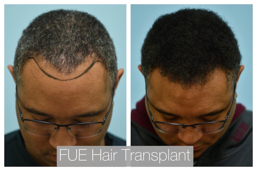Lam Institute for Hair Restoration – Samuel M. Lam, MD, FACS FISHRS gallery photo