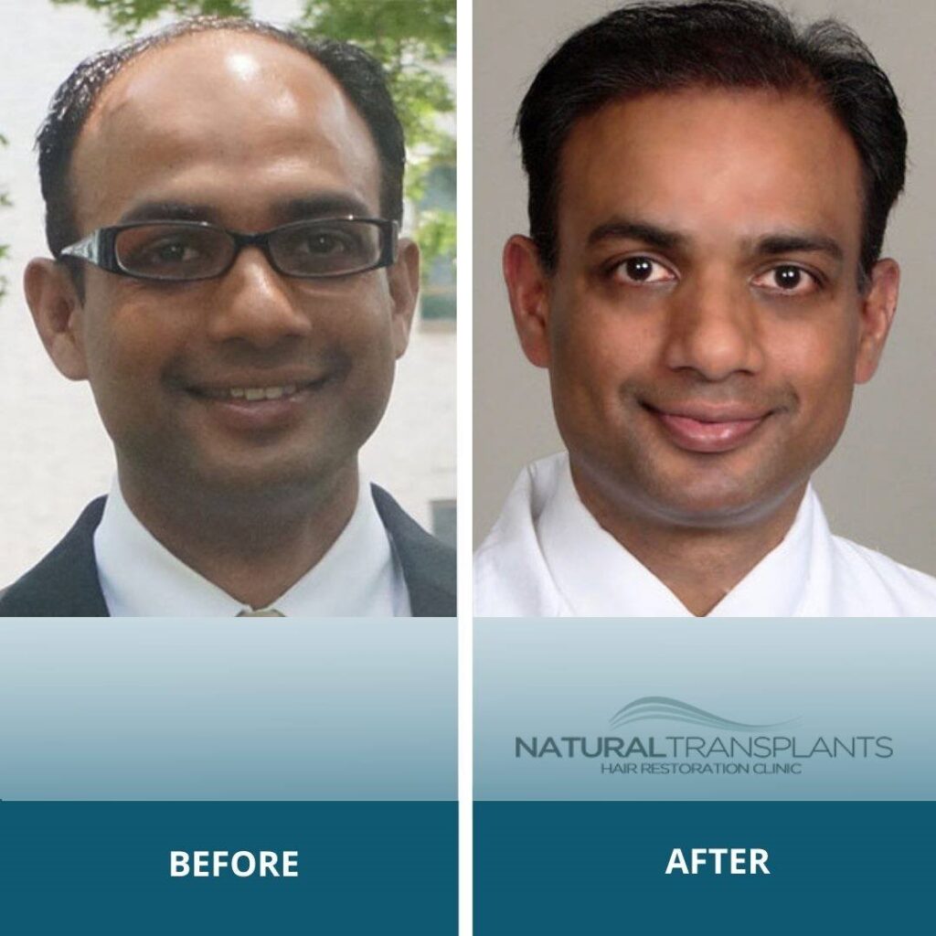 Natural Transplants, Hair Restoration Clinic gallery photo
