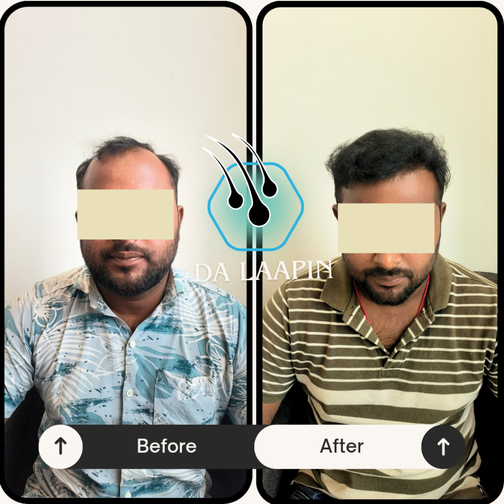 DA LAAPIN Hair Restoration Center gallery photo