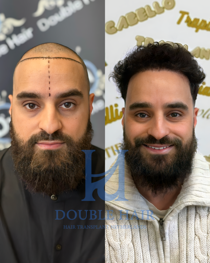 Double Hair Netherlands gallery photo