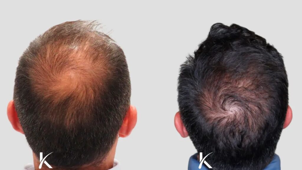 Kopelman Hair Restoration Boca Raton | Hair Transplant Clinic gallery photo