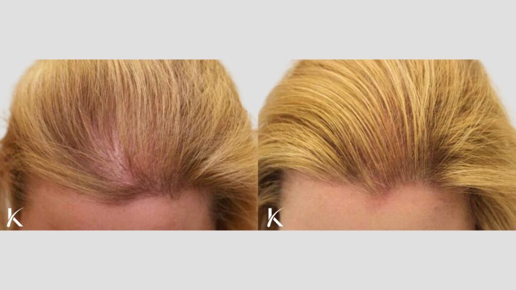 Kopelman Hair Restoration Boca Raton | Hair Transplant Clinic gallery photo