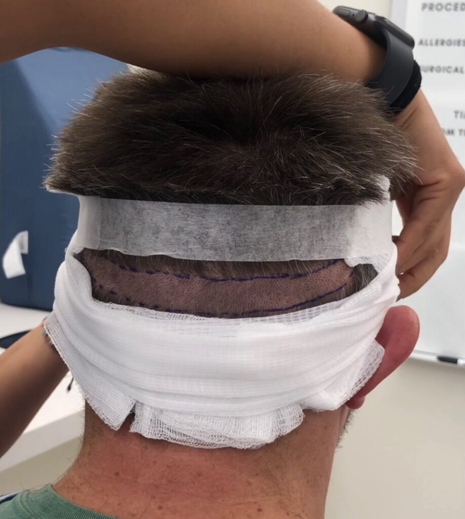 UFP Hair Restoration – Draper gallery photo