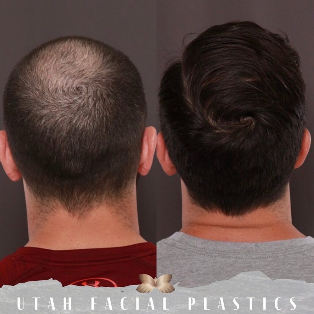 UFP Hair Restoration – Draper gallery photo