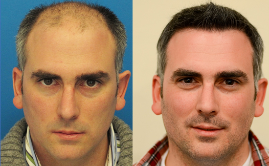 Hasson & Wong Hair Transplant Clinic Seattle gallery photo