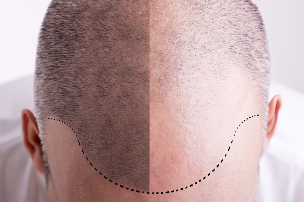 Oak Brook Hair Transplant gallery photo