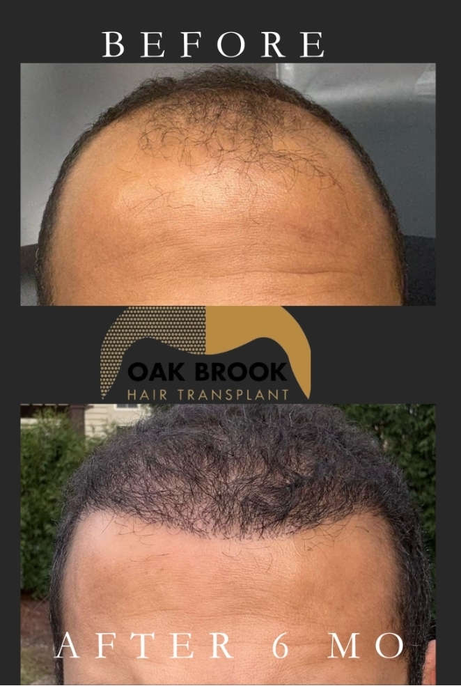 Oak Brook Hair Transplant gallery photo