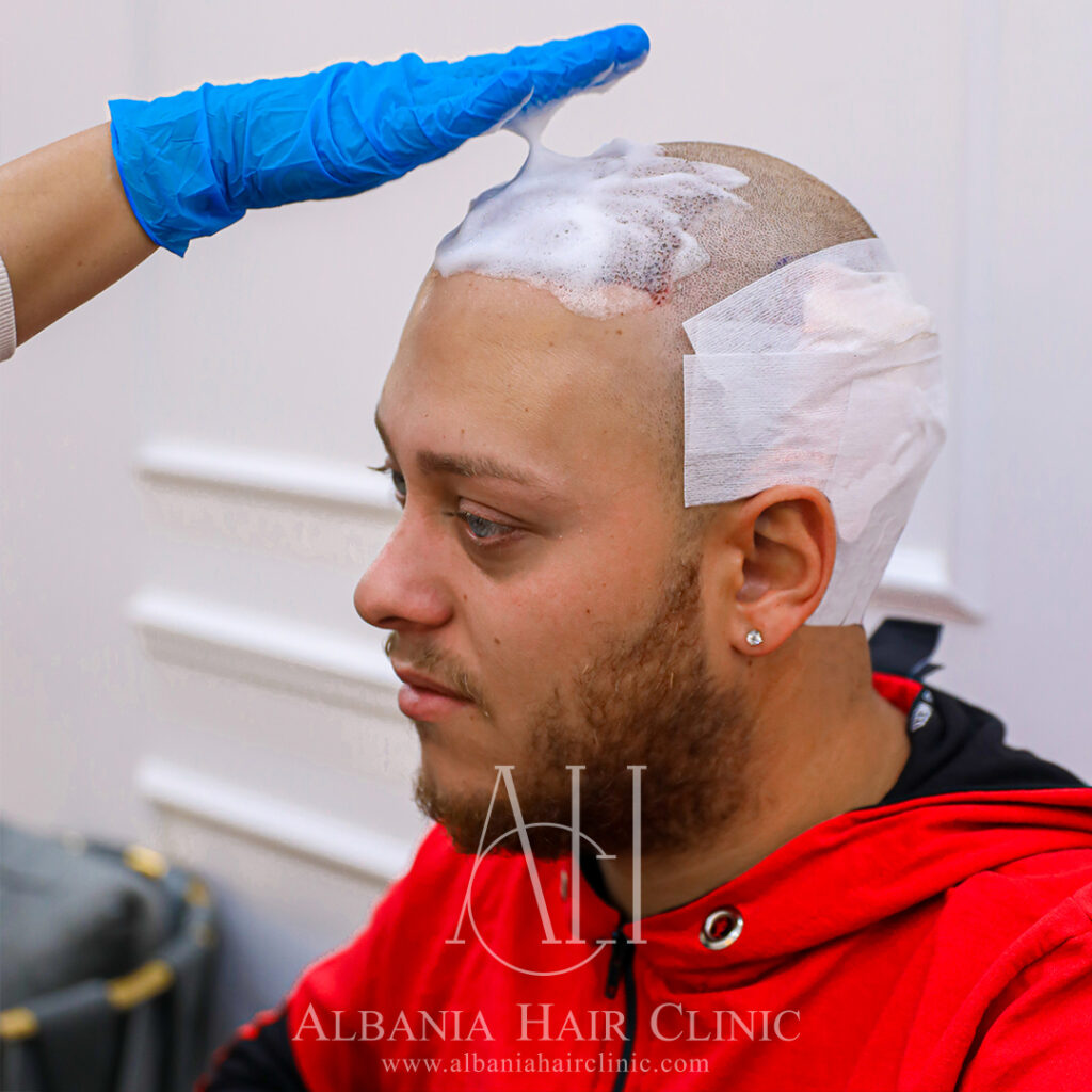 Trapianto Di Capelli | Albania Hair Clinic gallery photo