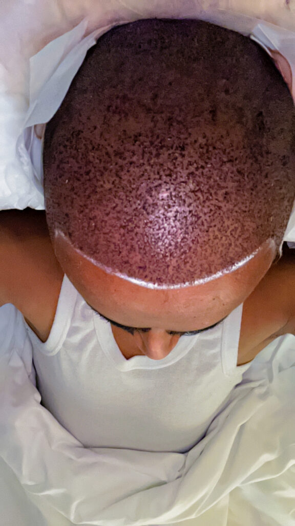 Trapianto Di Capelli | Albania Hair Clinic gallery photo