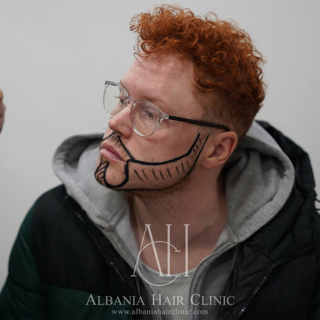 Trapianto Di Capelli | Albania Hair Clinic gallery photo