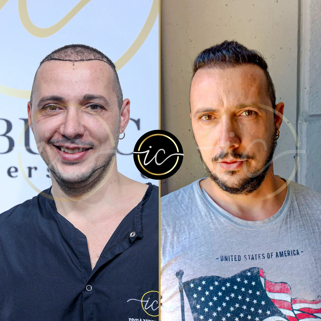 Istanbul Care Bulgaria | Hair Transplant – Dental – Plastic Surgeries gallery photo