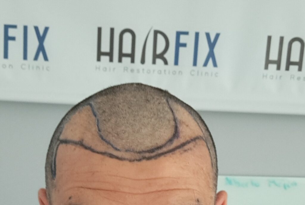 Hairfix | Hair Restoration Clinic gallery photo