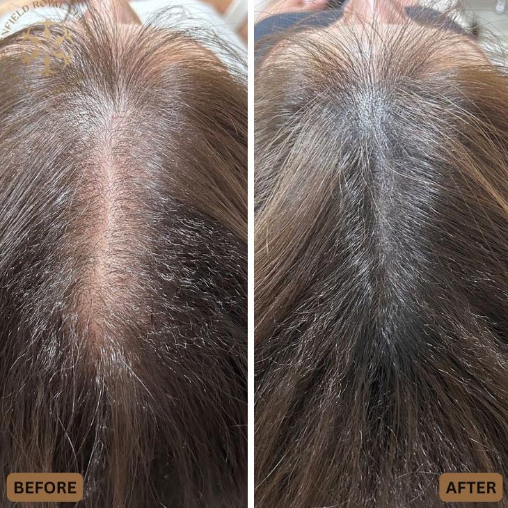 Dr Naveed Azhar – Hair Transplant in Islamabad | PRP Hair Treatment | Exosomes Therapy gallery photo