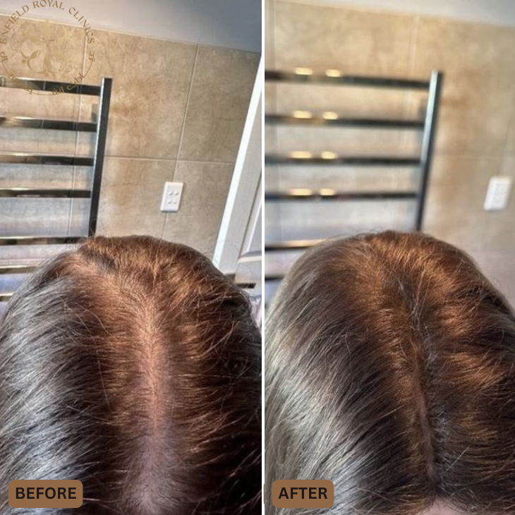Dr Naveed Azhar – Hair Transplant in Islamabad | PRP Hair Treatment | Exosomes Therapy gallery photo
