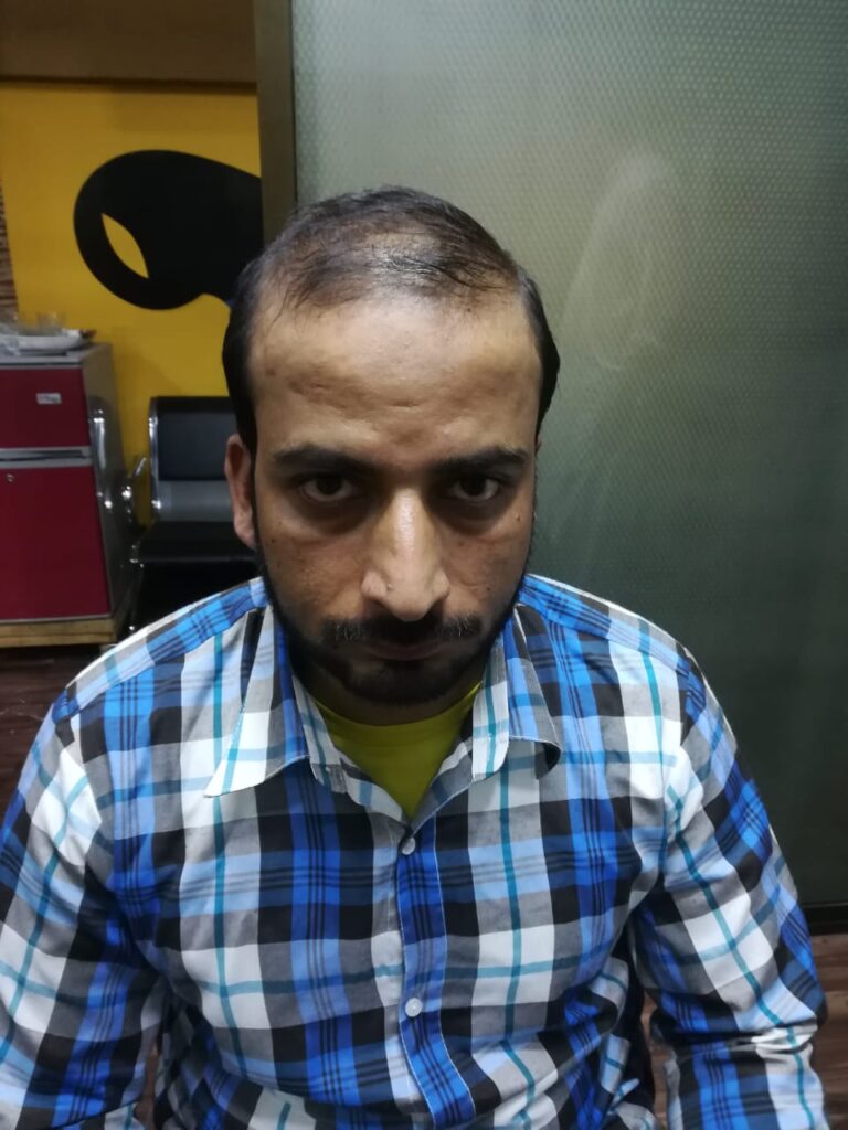 Hair Zone Care Center – Hair Replacement & Hair Transplant Lahore gallery photo