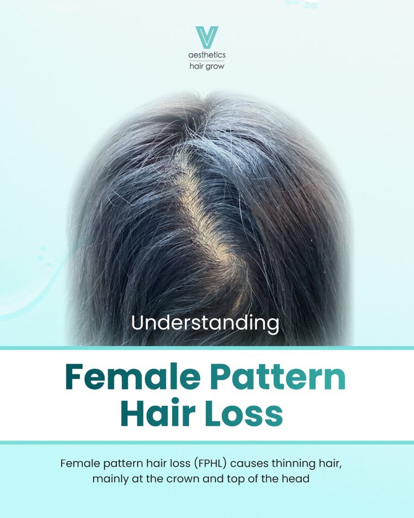 V Aesthetics Hair Grow (Novena) | Singapore Hair Loss Treatments gallery photo