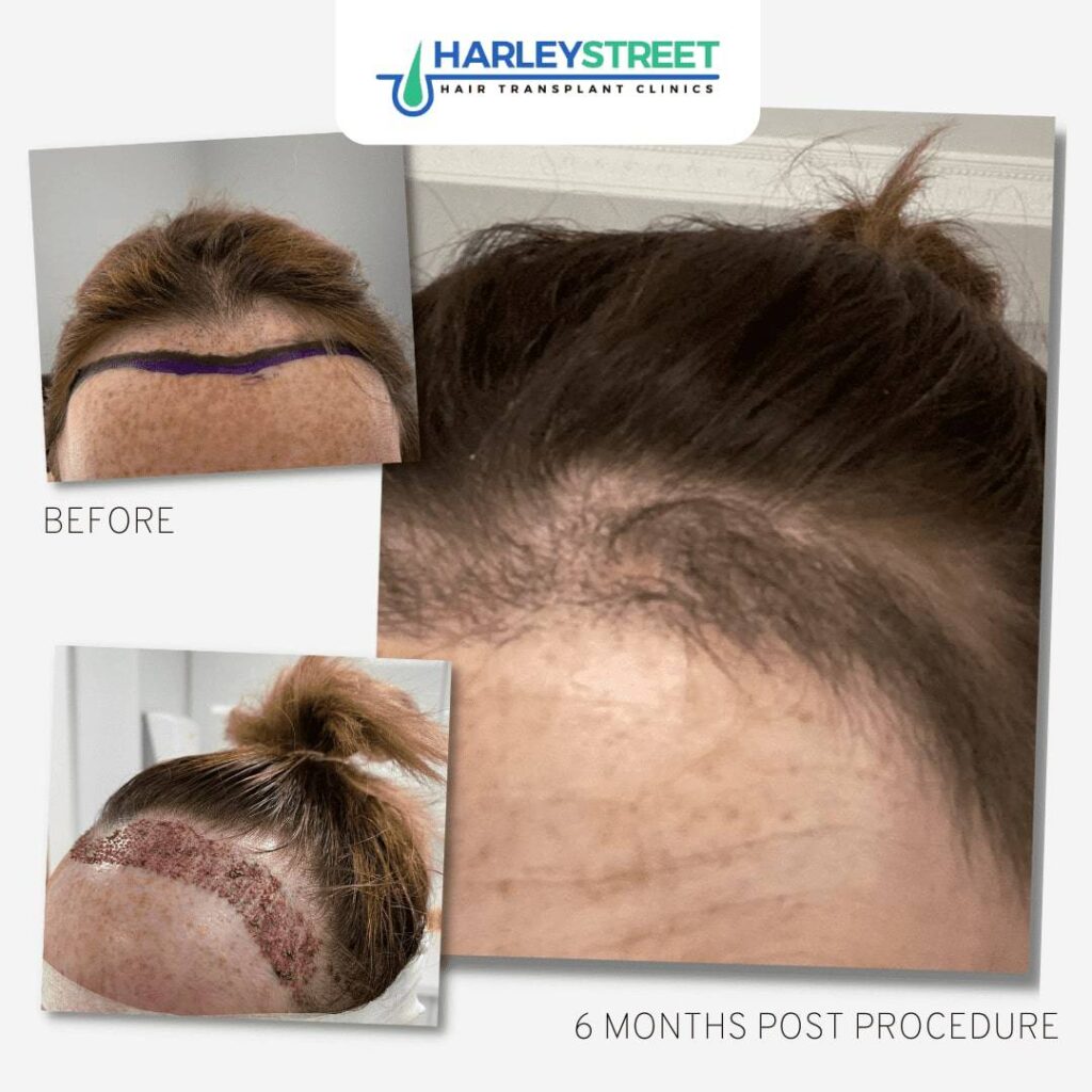 Hair Transplant Nottingham gallery photo