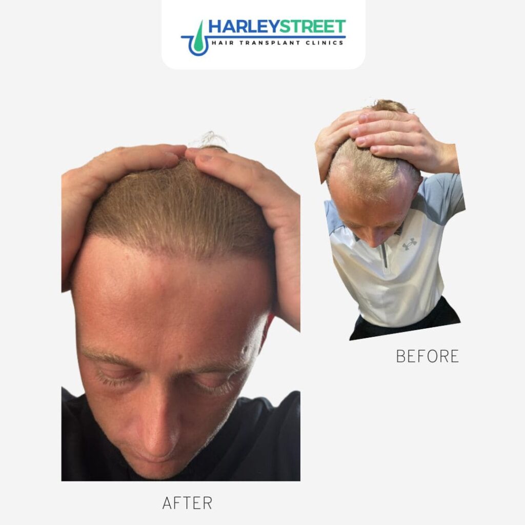 Hair Transplant Nottingham gallery photo