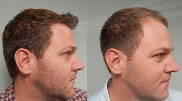 Natural Transplants, Hair Restoration Clinic gallery photo