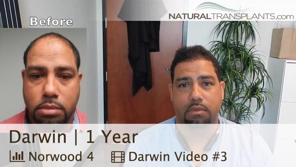 Natural Transplants, Hair Restoration Clinic — clinic photo from Google Maps
