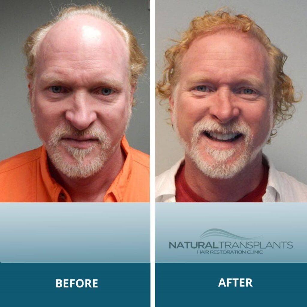 Natural Transplants, Hair Restoration Clinic gallery photo