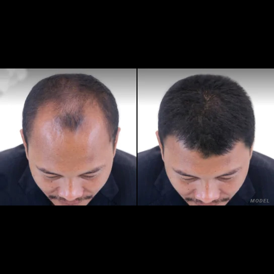 Premier Hair Restoration: Dr. Colin O’Dea gallery photo