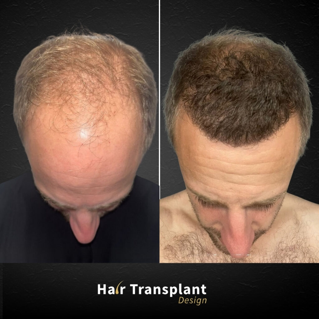 Hair Transplant Design — clinic photo from Google Maps