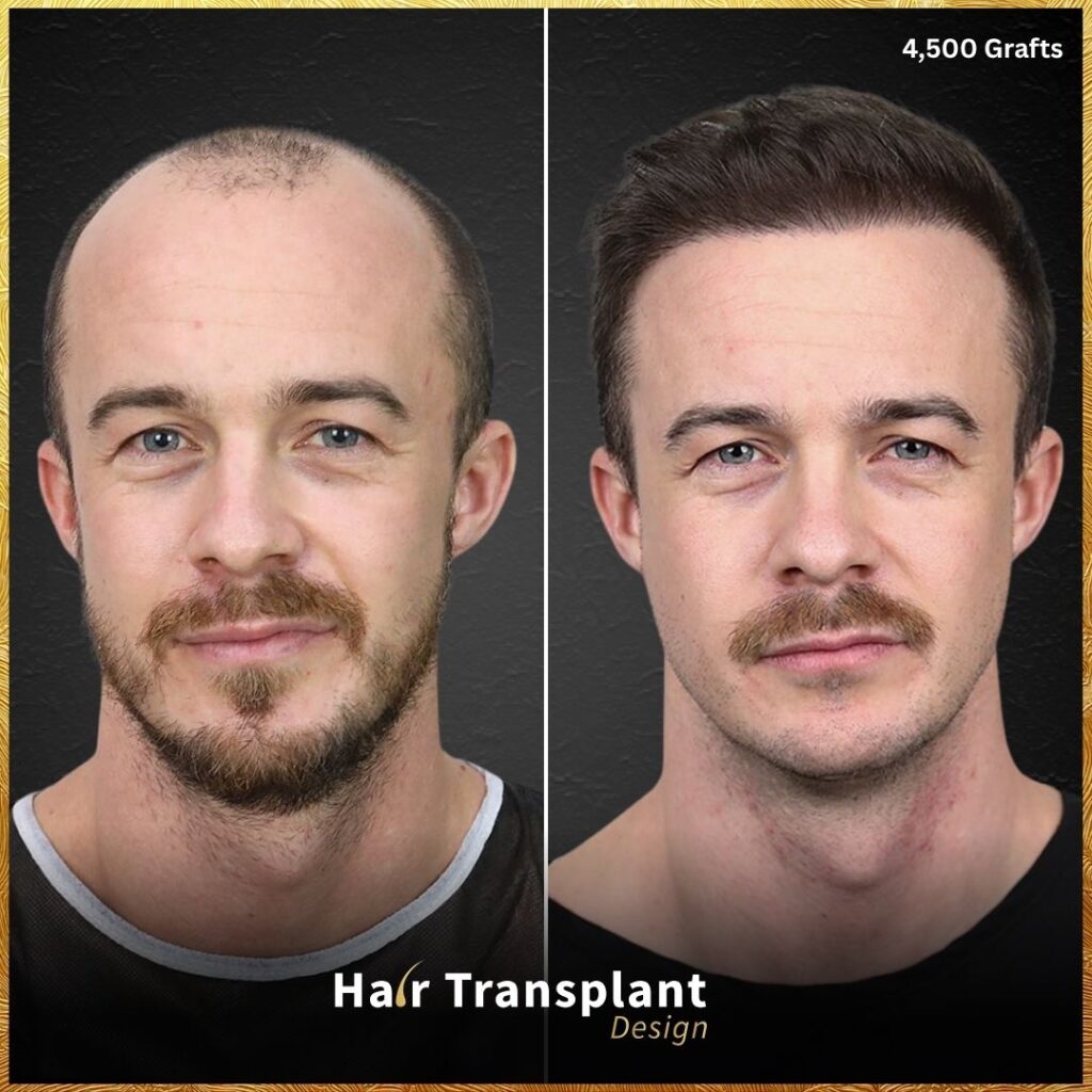 Hair Transplant Design gallery photo