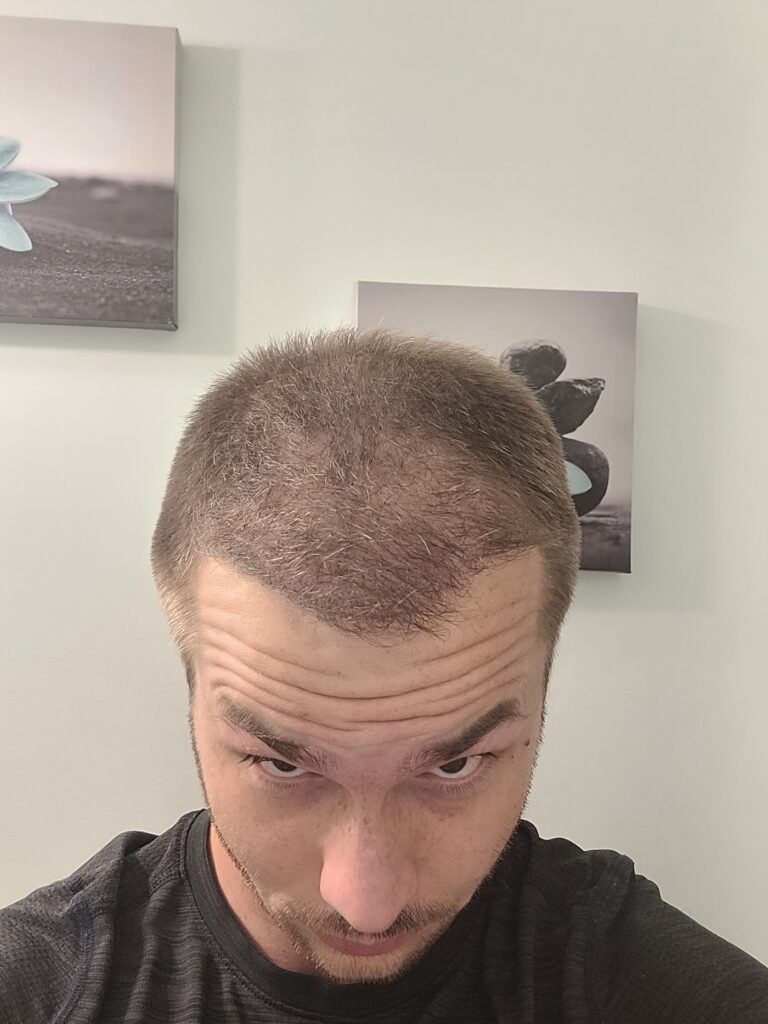 Hair Transplant Medical Centre Mississauga & Toronto | Hair Loss Treatment gallery photo