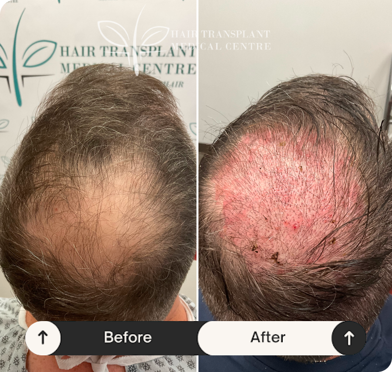 Hair Transplant Medical Centre Mississauga & Toronto | Hair Loss Treatment gallery photo