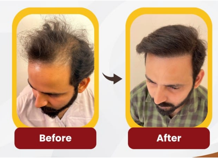 Crown- The Hair Transplant Experts gallery photo