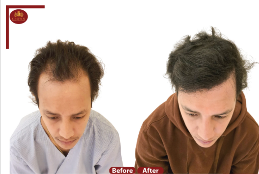 Crown- The Hair Transplant Experts gallery photo
