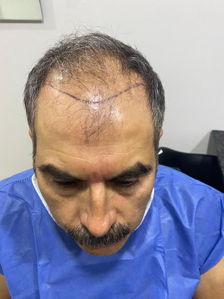 International Hair Transplant Clinic Tijuana gallery photo