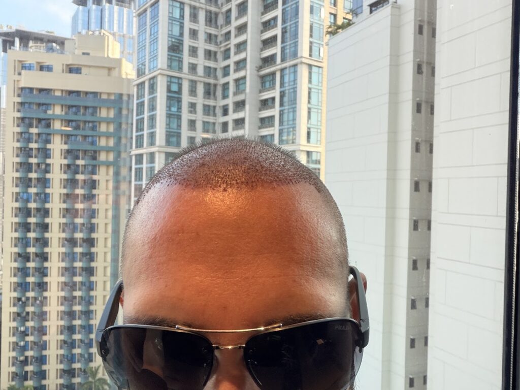 Pineda Hair Transplant Clinic | Hair Loss Solution Philippines gallery photo
