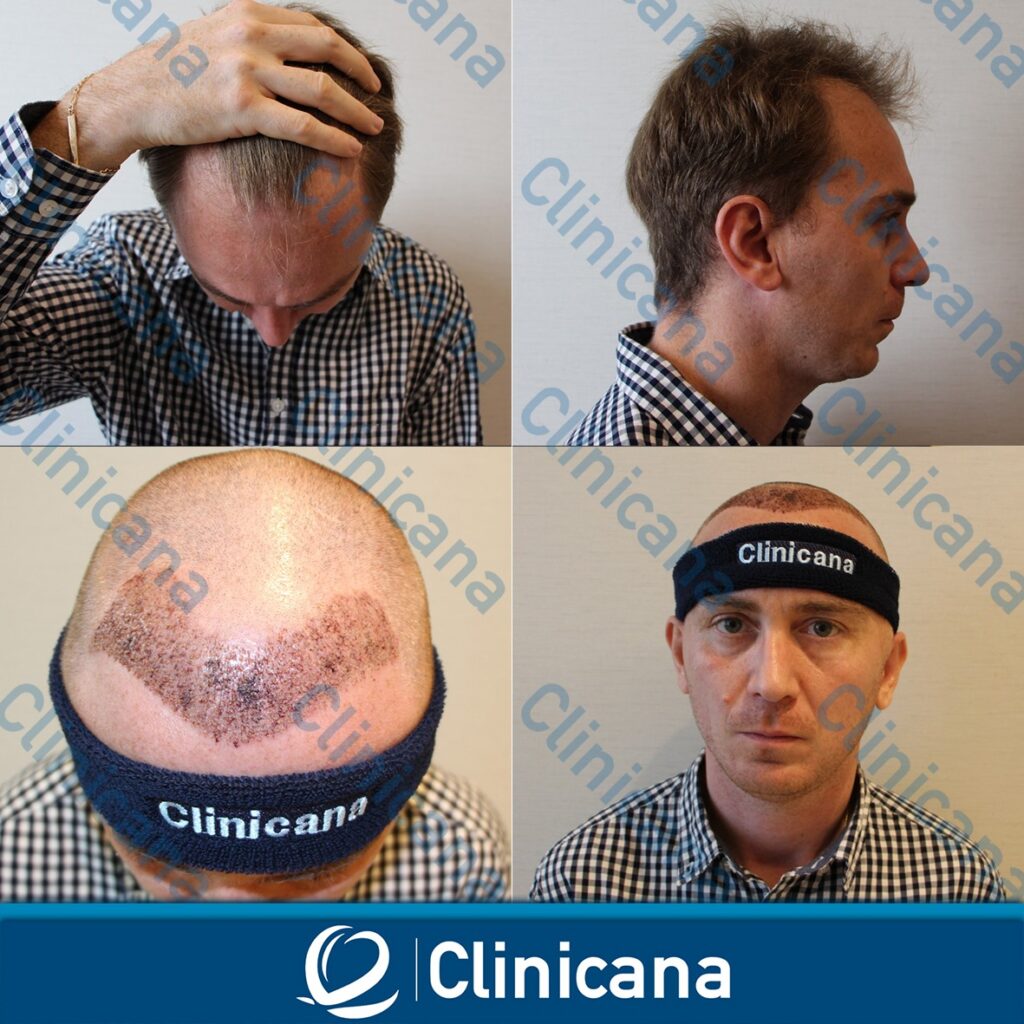 Clinicana Implant de Păr gallery photo