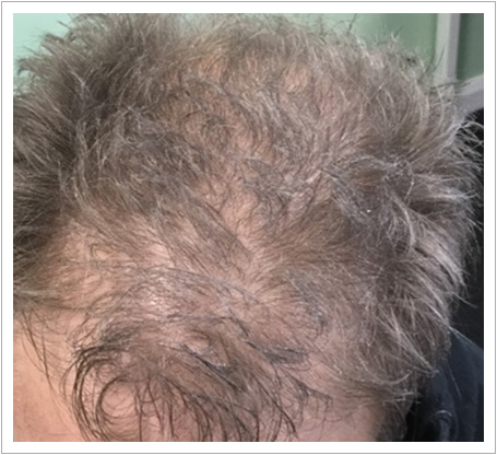 UK Hair Transplant Clinics Birmingham gallery photo