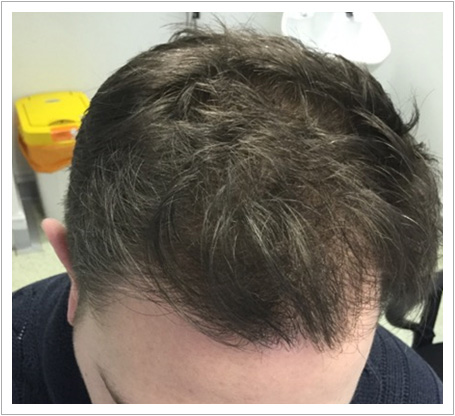UK Hair Transplant Clinics Birmingham gallery photo