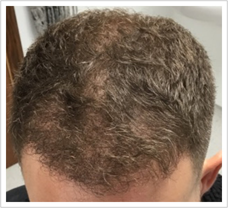 UK Hair Transplant Clinics Birmingham gallery photo