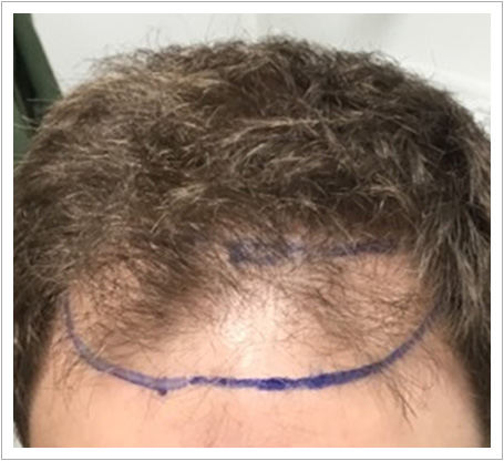 UK Hair Transplant Clinics Birmingham gallery photo