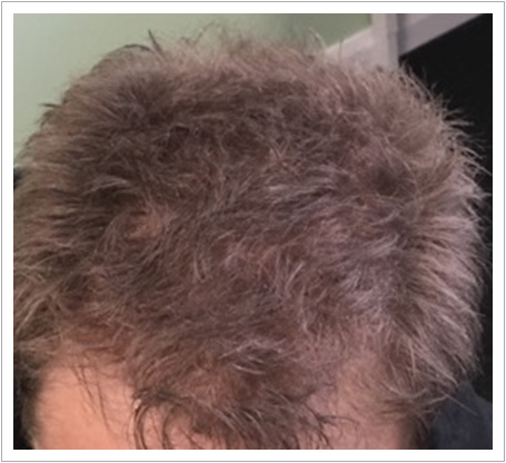 UK Hair Transplant Clinics Birmingham gallery photo