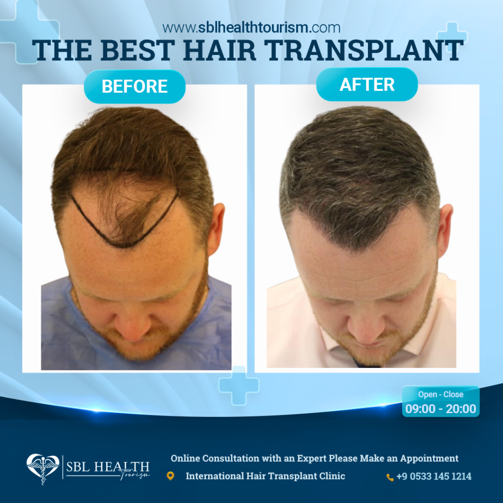 The Best Hair Transplant – FUE Maximum Graft in 1 Day Dubai Clinic / SBL Health gallery photo