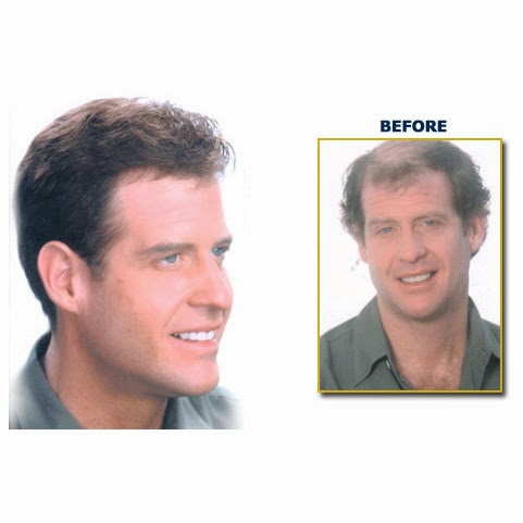 Raveen Hair Replacement gallery photo