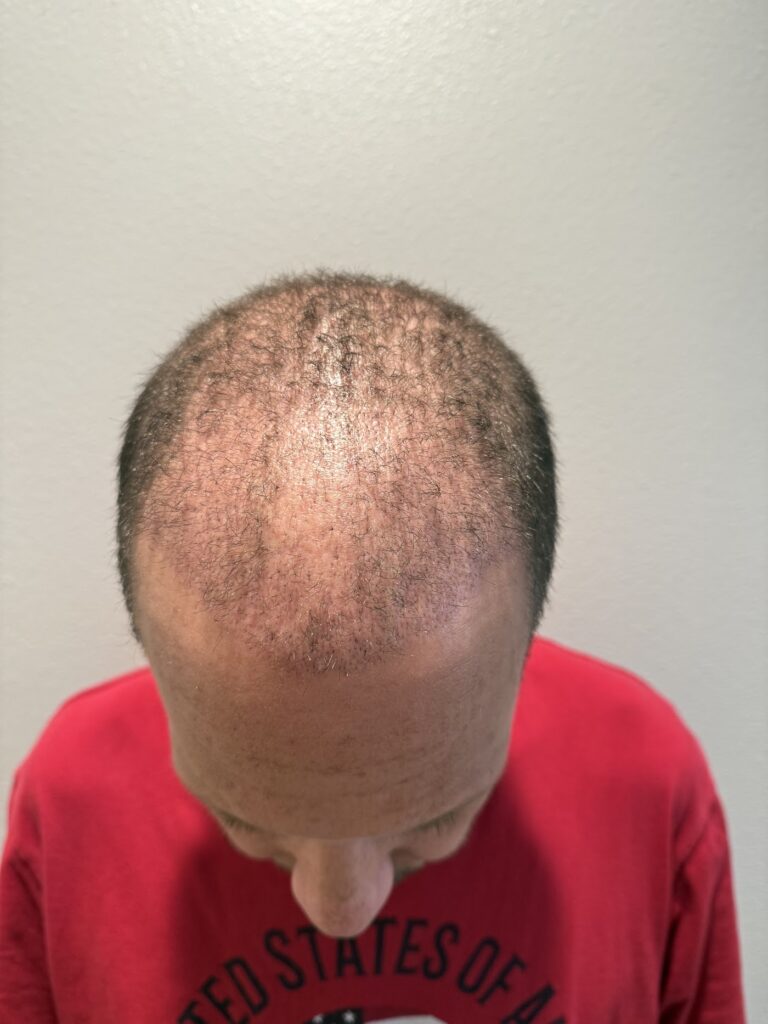 Best Hair Transplants Los Angeles gallery photo