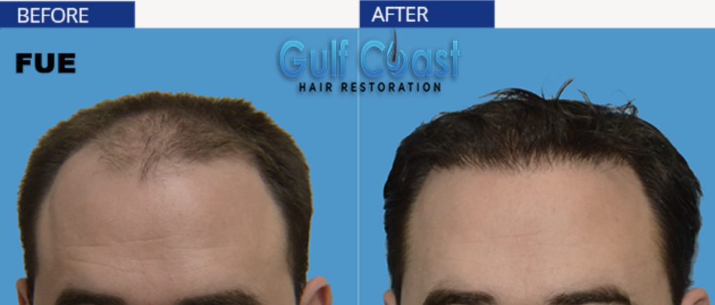 Gulf Coast Hair Restoration gallery photo