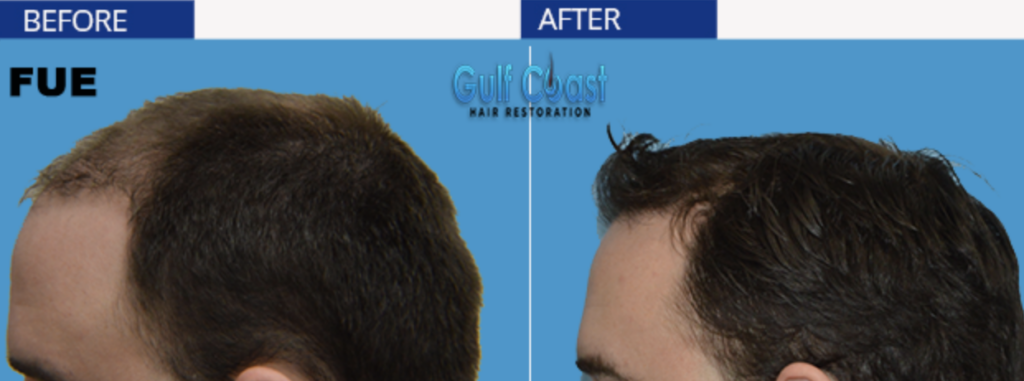 Gulf Coast Hair Restoration gallery photo